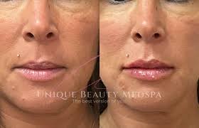 Lip Injections Near You