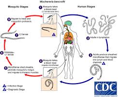 Browse 116 elephantiasis stock photos and images available or search for filariasis to find more great stock photos and pictures. Cdc Lymphatic Filariasis Biology Life Cycle Of Wuchereria Bancrofti