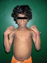 Congenital generalized lipodystrophy is a rare autosomal recessive disorder in which near total absence of the adipose tissue is evident from the birth. Indian Journal Of Dermatology Venereology And Leprology Congenital Generalized Lipodystrophy Of Berardinelli Seip Type A Rare Case