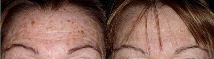 Sun Damage Treatments - Treatments to repair sun damaged skin