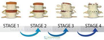 Can Stem Cells Help Reverse Degenerative Disc Disease
