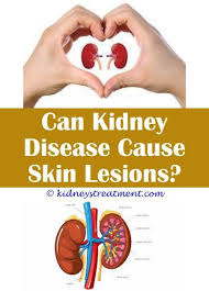 N heart failure in time n arrhythmias n severe atherosclerosis n renal disease n stroke n aortic wall. Healthregular On Twitter Common Kidney Diseases Ppt Kidney Disease Nails Chronic Kidney Disease Stage 5 S Https T Co Eqi4rv97l5