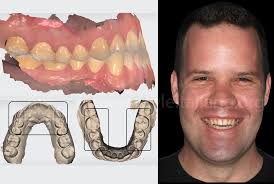 Full Mouth Rehabilitation of a complex wear case, the digital approach