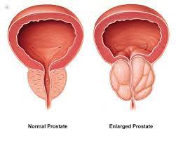 If this cancer is caught early, it's treatable. Everything You Need To Know About Prostate Cancer