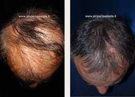Diffuse alopecia can be categorised into conditions that cause excessive hair shedding and conditions that cause hair thinning 1. Alopecia Areata Diffusa Nuovi Risultati Prima E Dopo Terapia Medicitalia It
