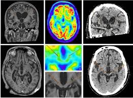 Image result for Thalamic Stimulation