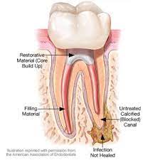 A Second Root Canal Treatment May Help Save An Endangered Tooth Robbinsdale Dentalcare
