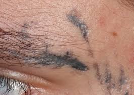 We have been exploring whether tattoos can cause skin cancer. Inflammatory Tattoo Reaction Dermatology Advisor