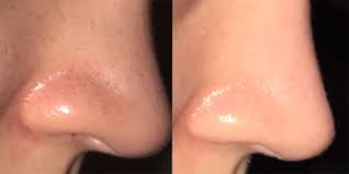 Read my story to see what worked and what changed my life. How To Get Rid Of Blackheads According To Reddit Blackhead Treatments