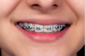 Brackets Cerca Amb Google Brackets Dentales Ligas Para Brackets Ortodoncia Brackets