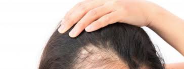 While increased hair loss can be the result of. What Causes Hair Loss Revive Hair Loss Solutions