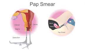 Also get information on testing for hpv and on the hpv vaccines. Pap Smear Bantu Kesan Kanser Serviks Hello Doktor