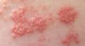 How Long Did It Take You To Heal From Shingles?