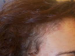 ☐ thinning (or missing) eyebrows on the outer edge. Hair Loss Dermnet Nz