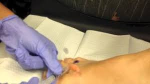An intrauterine device is a plastic device shaped like a t that is placed in the uterus to prevent pregnancy for five to ten years. Procedure Videos Dr Jeff M D