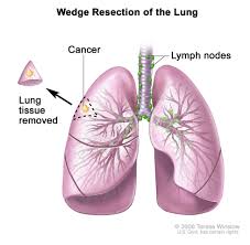 Furthermore, how long can you live with cancer without knowing it? Non Small Cell Lung Cancer Treatment Pdq Patient Version National Cancer Institute
