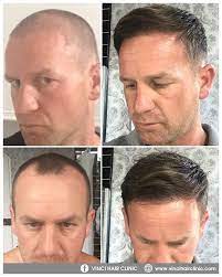 Vinci Follicular Unit Extraction Fue Vinci Hair Clinic Hair Clinic Hair Transplant Hair Transplant Results