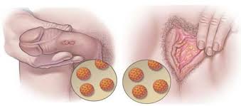 L'infezione genitale da papilloma virus umano (hpv) è forse la malattia sessualmente trasmissibile (mst) più comune e prima o poi nella vita colpisce quasi il virus non è riconoscibile negli uomini che non manifestano sintomi e può restare in una fase dormiente per anni, prima di provocare qualche. O Que E Hpv Patologia Vs Diagnostico