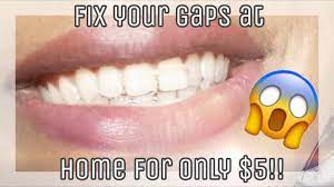 Adults and children can benefit from them. How To Straighten Teeth Without Braces At Home In Hindi Teethwalls