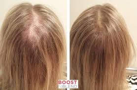Postpartum hair loss is perfectly normal. 6 Ways To Hide Hair Loss And Thinning Hair In A Female Boost N Blend Uk