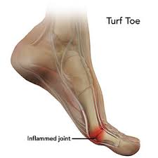 If the injury is severe (e.g., if you have a torn. Turf Toe Pain Injury Sydney Nsw Turf Toe Fracture Randwick
