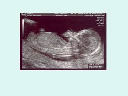 What is obstetric nuchal dating scan. Obstetric Ultrasound Scan Dr Asma Basha Fetomaternal Medicine