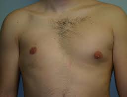 Implant reconstruction was not possible due to patient. Before And After Breast Reconstruction Image 2694