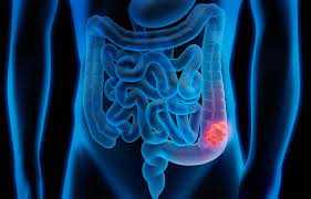 Chemotherapy may also be used after surgery (called adjuvant treatment).most adjuvant treatment is given for about 6 months. Stage 3 Colon Cancer Symptoms Diagnosis And Treatment
