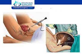What To Expect After Ovarian Cyst Surgery Ovarian Cyst Surgery Recovery