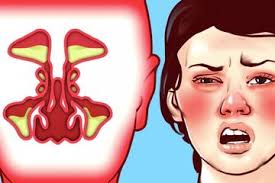 Hidung mampet atau tersumbat sebagian atau keduanya bisa disebabkan datangnya gejala penyakit. Berita Hidung Tersumbat Terbaru Hari Ini Grid Health