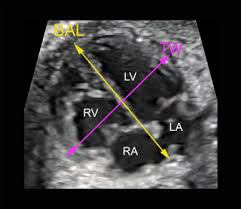Mobile and call of duty: Size And Shape Of The Four Chamber View Of The Fetal Heart In Fetuses With An Estimated Fetal Weight Less Than The Tenth Centile American Journal Of Obstetrics Gynecology