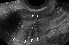 Maybe i could even go to university again. Transvaginal Us Of Endometriosis Looking Beyond The Endometrioma With A Dedicated Protocol Radiographics