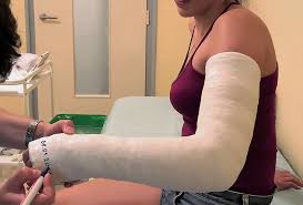 Image result for Long Arm Cast