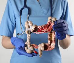 Image result for Colon Cancer Screening with Colonoscopy