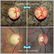 European glaucoma society, 4th edition, 2014. What Does Glaucoma Look Like Eyecing On The Cake
