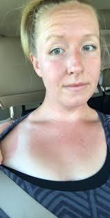 Using Original Skin Repair for Wind Burn in Ashland, WI