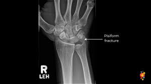 Image result for Pisiform Bone