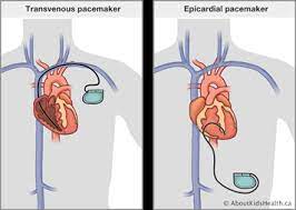 The pacemaker rhythm can easily be recognized on the ecg. Pacemaker Surgery