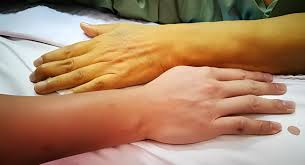 മലപ്പുറത്ത് മഞ്ഞപ്പിത്തം ബാധിച്ച് യുവാവ് മരിച്ചു; രണ്ടു ദിവസത്തിടെ മൂന്നു മരണം; ജാഗ്രത