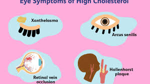 High Cholesterol And The Eyes Signs And Symptoms
