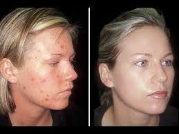 How To Cure Acne Clear Skin In One Week Acne Cure Acne Treatment Best Acne Treatment
