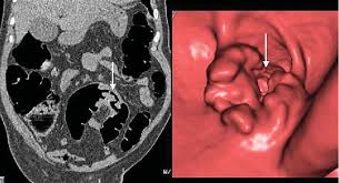 Image result for Virtual Colonoscopy