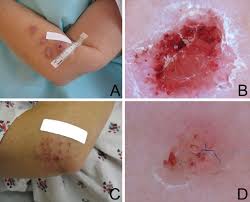 Morgellons is not well understood, but the general medical consensus is that it is a form of delusional parasitosis. Joni Mitchell Suffers From A Disease Most Doctors Think Isn T Real Vox