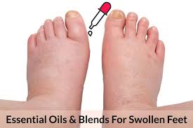 It also works to combat athlete's foot and leave your feet smelling fresh. Essential Oils For Swollen Feet When Your Feet Are More Bloated Than A Puffer Fish Laptrinhx News