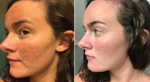 What other supplements are good for your skin? Vitamin C For Acne Scars Reddit