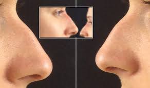 Non Surgical Nose Job V Rhinoplasty Before After Transformation Pictures Revealed Express Co Uk