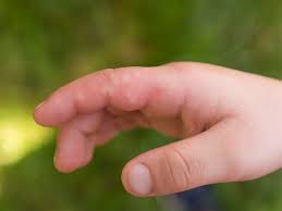 On l'appelle également lucite estivale bénigne (une forme d'allergie au soleil, lire. Non Food Allergies In Children Raising Children Network