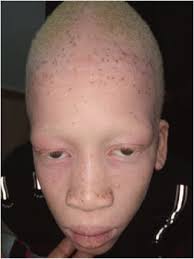 Genotypic spectrum of albinism in Mali