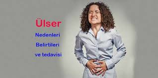 Ulser Nedir Neden Olur Belirtileri Ve Tedavi Yontemleri