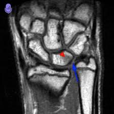 Comparison Of Diaphyseal And Metaphyseal Ulnar Shortening Osteotomies For  The Treatment Of Ulnar Impaction Syndrome | Bmc Musculoskeletal Disorders |  Full Text